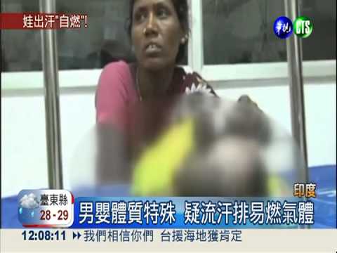 流汗就自燃 印3月嬰遭火吻4次