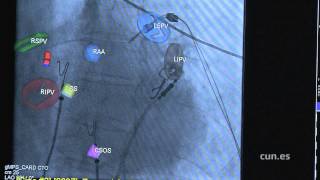 Tratamiento de arritmias más seguro y preciso (Clínica Universidad de Navarra)