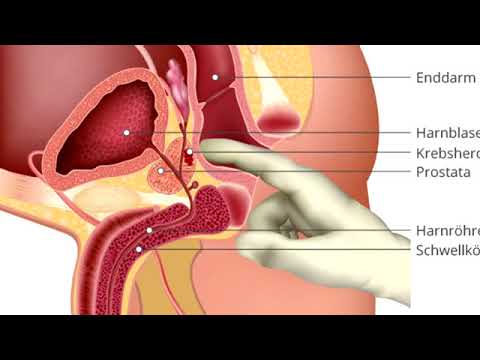 Prostatitis, was die Medizin zu nehmen Schmerzen in dem Prostata-Anhängsel