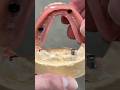 2-Locator Denture #dental #teeth #smile #lsk121shorts #shortvideo #shorts #dentures