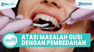 Tanda Warna Gusi Tidak Sehat, Begini Cara Mudah Mengatasi Masalah Gusi dengan Tidakan Bedah