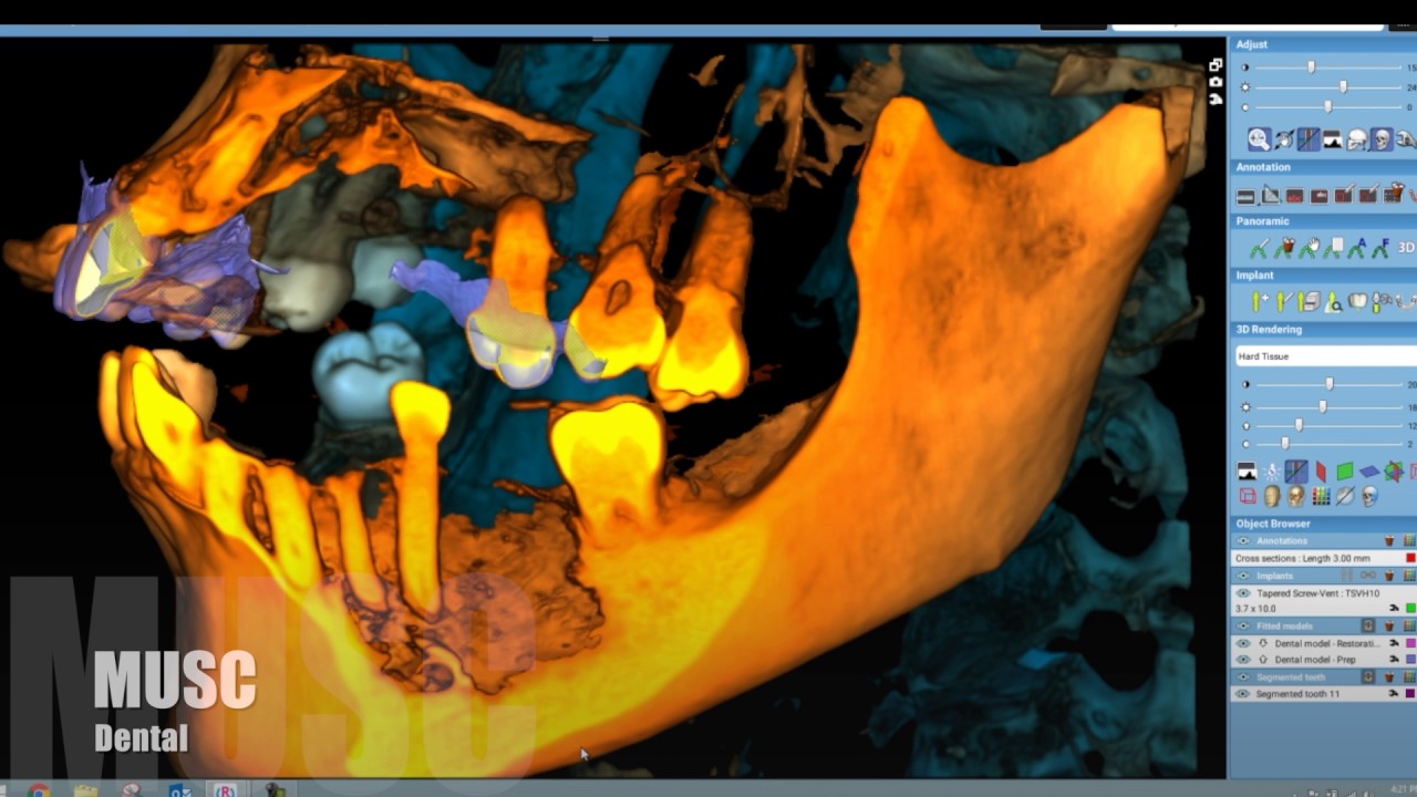 3D printed surgical guide Romexis Planmeca Planscan