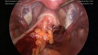 Download Lagu Laparoscopic Frykman - rectal prolapse repair Thumbnail