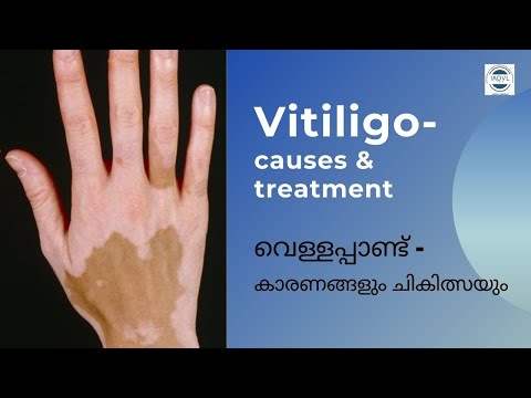 Vitiligo causes and treatment| വെള്ളപ്പാണ്ട് കാരണങ
