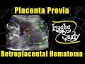 Complete Placenta Previa with Retroplacental Hematoma || Ultrasound || Case 98