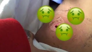 MRSA infection ( I have a hole in my leg )