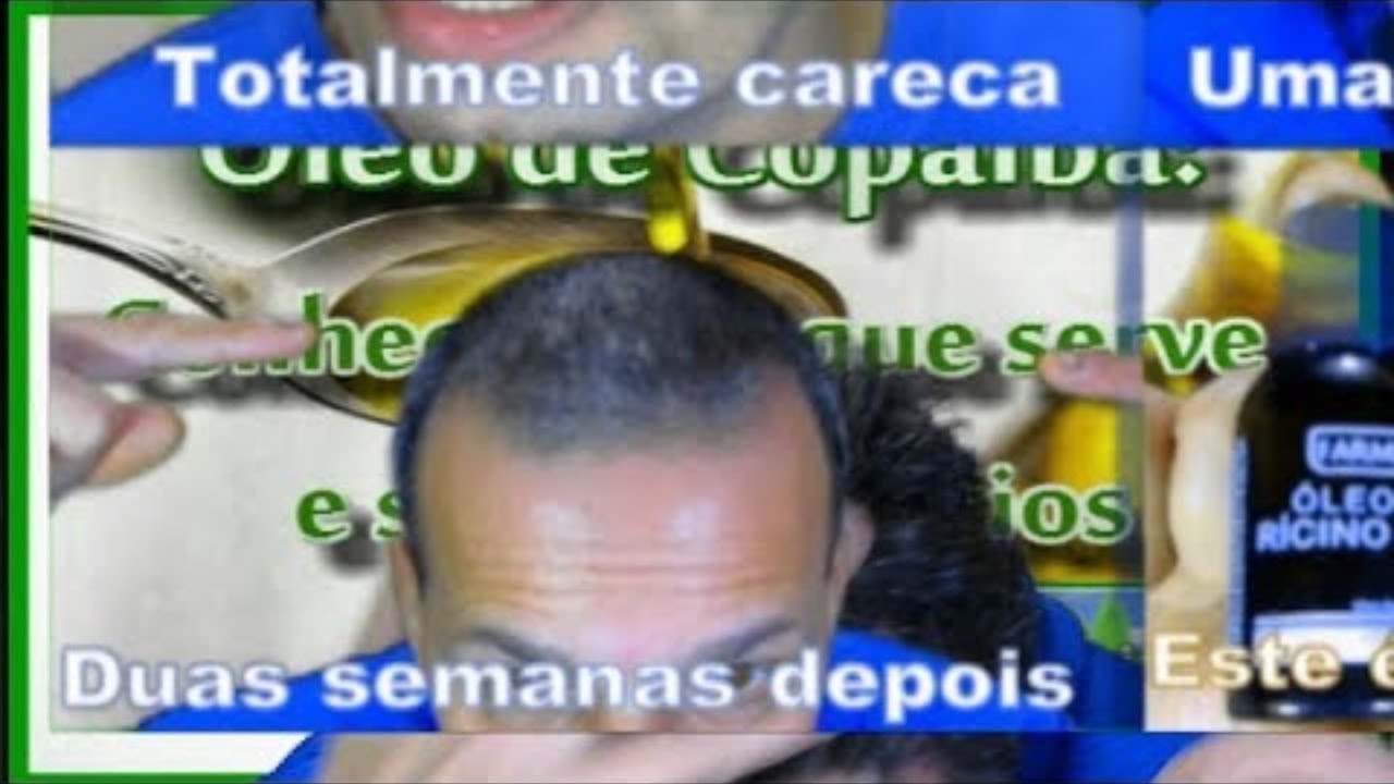 Óleo de Copaíba fortalece e evita a queda de cabelos. Saiba como usar