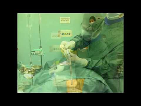 YouTube fisioterapia per osteocondrosi Da infiammazione e gonfiore delle articolazioni