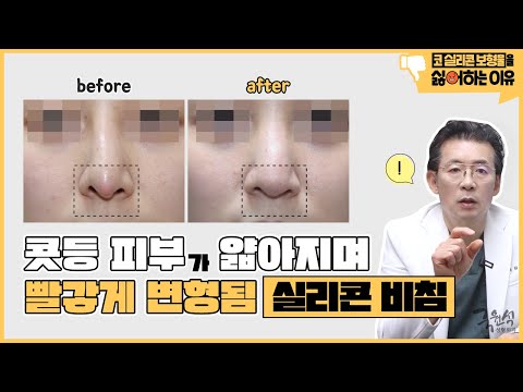 #코성형 부작용 중 가장 흔하게 나타나는 증상은?