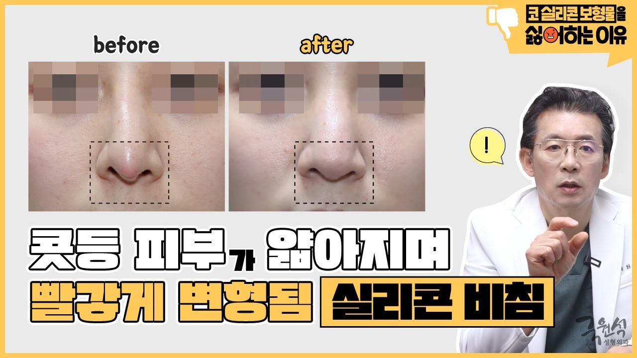 #코성형 부작용 중 가장 흔하게 나타나는 증상은? 썸네일