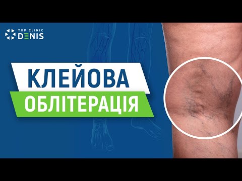 Лікування варикозу біоклеєм: що потрібно знати - TOP Clinic DENIS