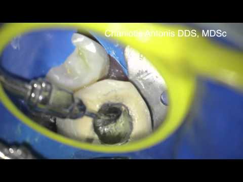 Antonis Chaniotis "MANI microfiles broken instrument removal"