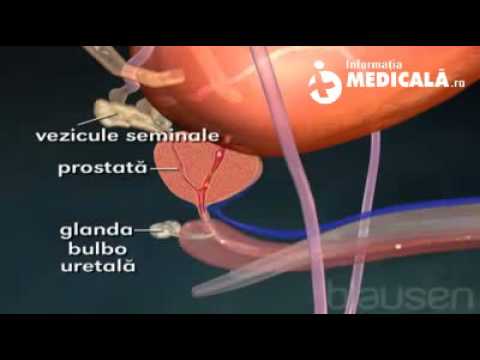 Chronische prostatitis prostata entfernen
