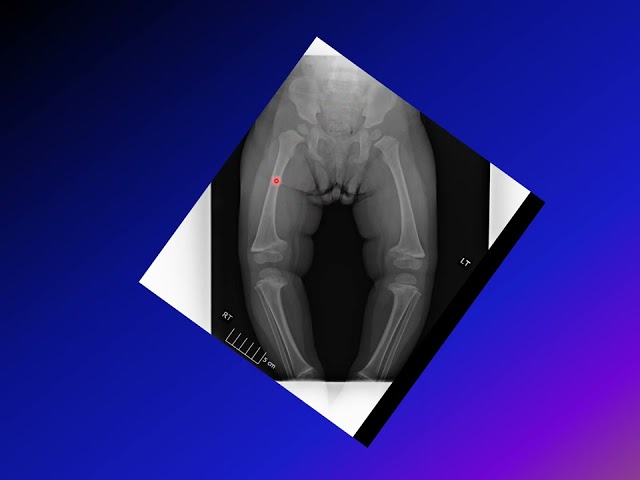 Understanding Blount's Disease: Pathology, Diagnosis, and Treatment ...
