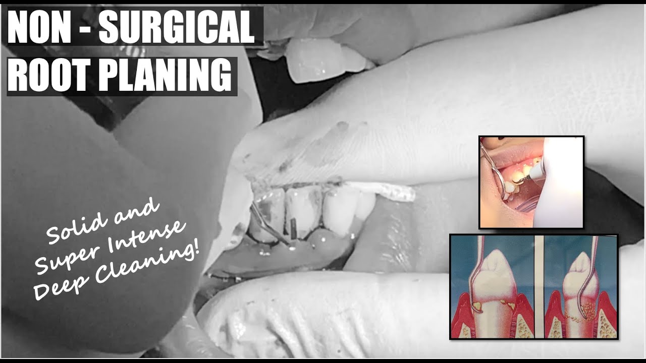 Non - Surgical Root Planing (Super Intense Cleaning) | Apostol Dental Philippines