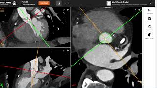 New FEops HEARTguide -  TAVI MPR