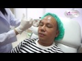 โบท็อก ลดริ้วรอย