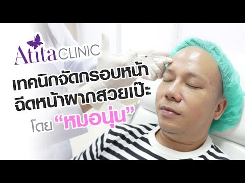 โบท็อก ลดริ้วรอย