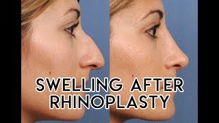 Swelling After Rhinoplasty