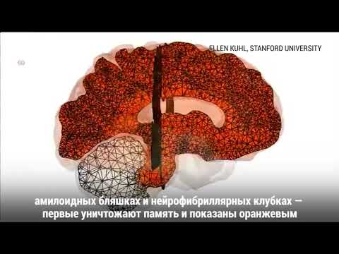 Как именно болезнь Альцгеймера поражает мозг