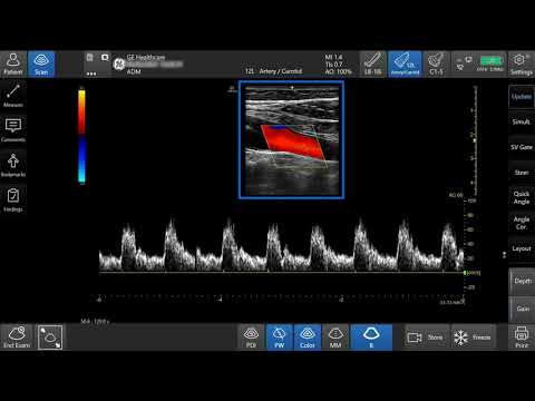 Venue™ Family R3 Tutorial - Pulse Wave Doppler