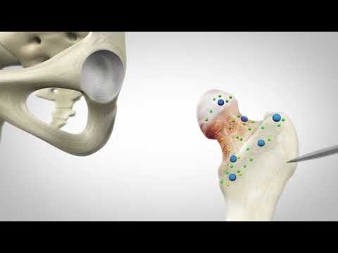 Reviewing The Mako Total Hip Robotic Procedure!