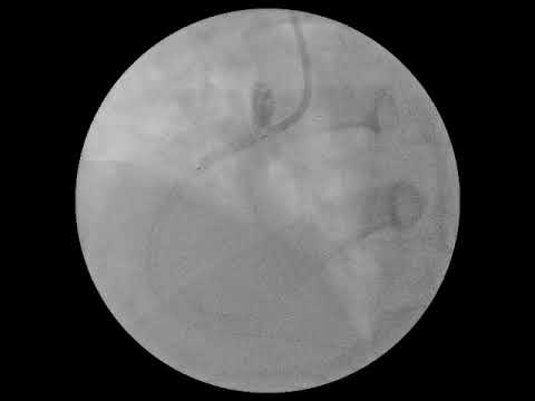 SUCCESSFUL PCI TO TIG INDUCED RCA OSTIAL DISSECTION & COMPLETE CLOSURE