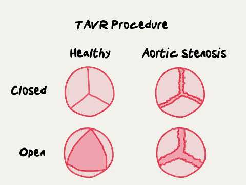 Doctor Explains TAVR procedure