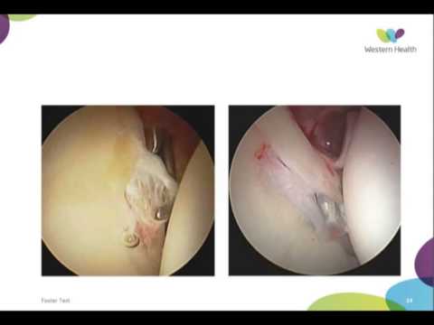 FAI and Labral Pathology of the Hip by Dr Peter Moore