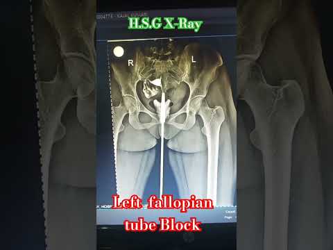 Left fallopian tube block (H.S.G) X-RAY #_shorts #_viral_ #_medical #_student #_collage