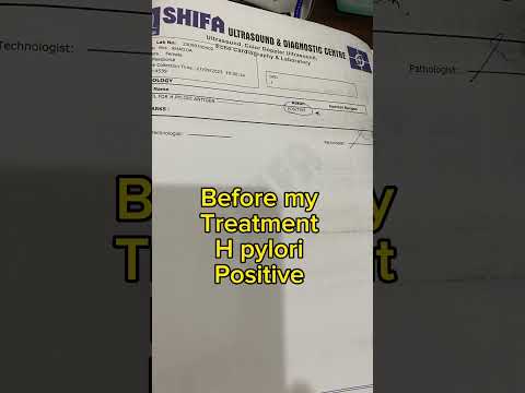 Another successful treatment of h pylori by Dr Arsalan Yousuf