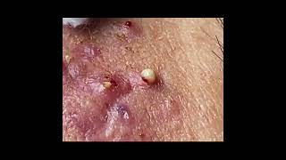 Ultimate Pimple Popping Compilation | Deep Cyst Removal & More!