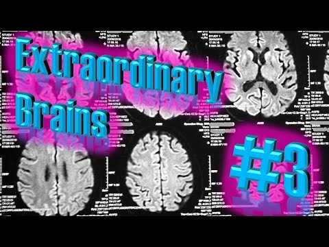 Creutzfeldt-Jakob Disease Case: A Brain Attacked By Abnormal Proteins | Extraordinary Brains #3