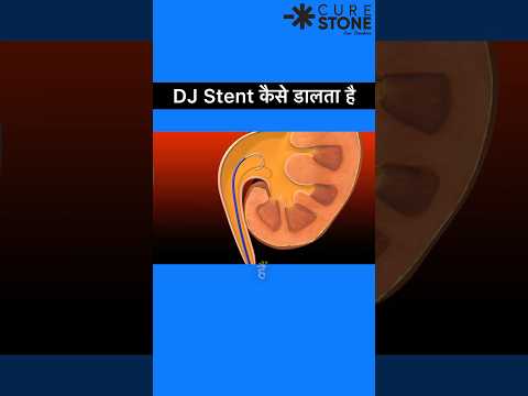 How DJ stent is placed | what is the function of DJ stent | Kidney stone treatment | rirs #doctor