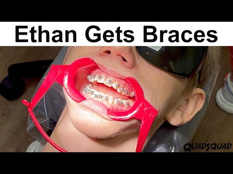 How Braces Are Put On