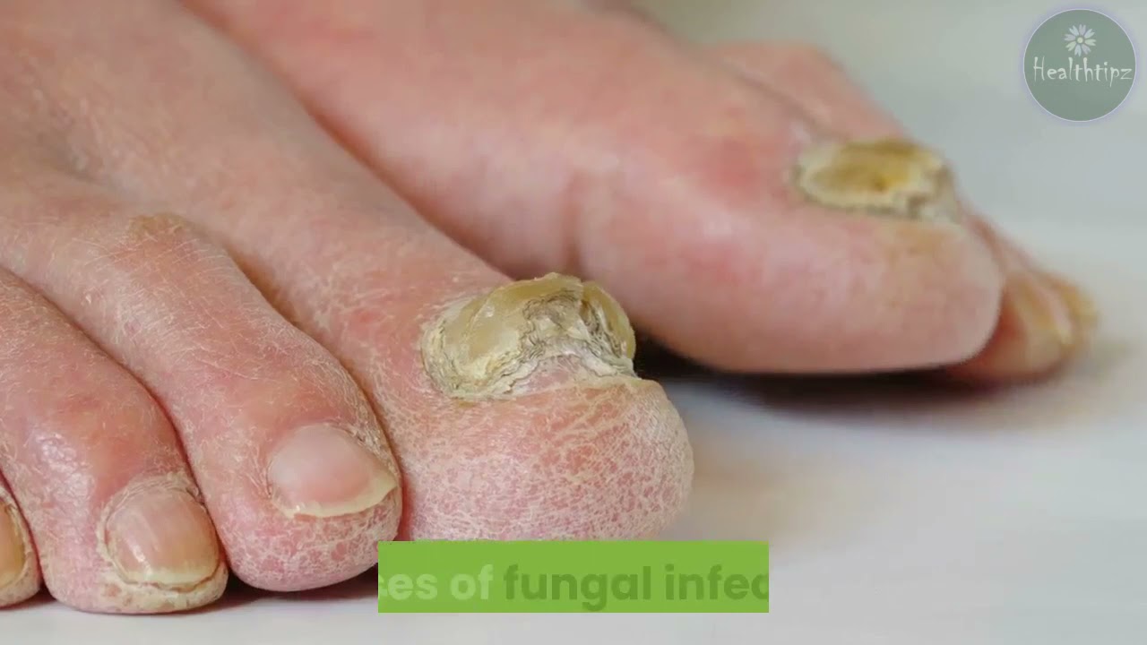 Psoriasis vs. Fungal Infection Tips for Identification and Treatments