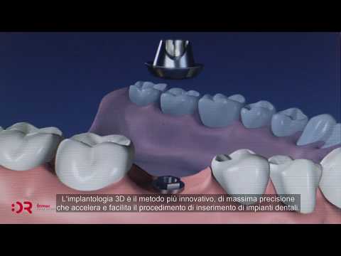 Impianti dentali | Zubni implantati | Ugradnja i Cijena | Štimac Centar dentalne medicine | Zubni implantati | Stomatološka poliklinika Zagreb | Štimac centar dentalne medicine