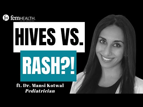 Hives Vs. Rash In Kids: Pediatrician Explains How To Tell The Difference