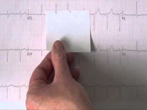 Master what to look for on every 12 lead ECG or EKG - workshop 2