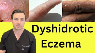 What is Dyshidrotic hand Eczema. Causes and treatment.