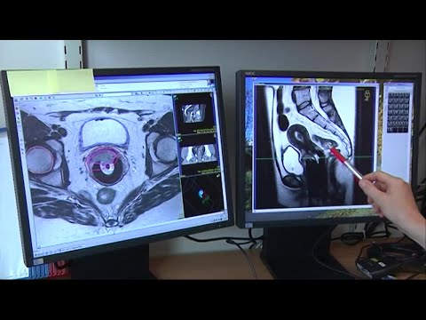 Besked om allmän prostatascreening - Nyheterna (TV4)