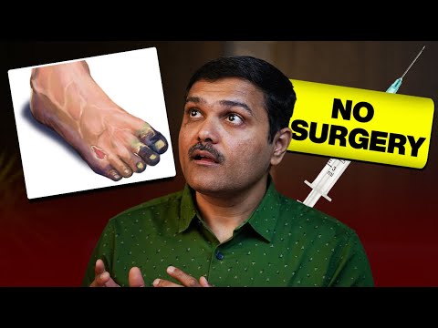 Cure for GANGRENE: New Non-Surgical Treatment Details #vascularexpert