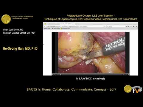 MILR of HCC in Cirrhosis