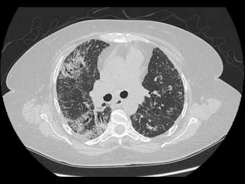 What is the pattern of CTD-ILD on HRCT for female 60 YO with Rheumatoid arthritis?