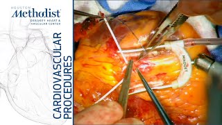 Download Lagu CABG Using Bilateral Internal Mammary Artery Conduits (Mahesh Ramchandani, MD, M. Mujeeb Zubair MD) Thumbnail