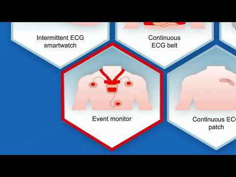 Improving Recognition of Nonvalvular Atrial Fibrillation to Reduce the Risk of Preventable Stroke
