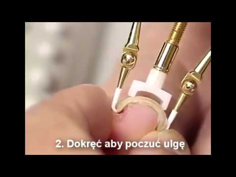 Chirurgiczne usunięcie stożki na palcach Zdjęcie koślawe kolana u dziecka