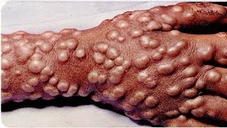 Stii care este cel mai mare succes din lume al vaccinarii? Afla aici!