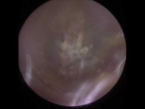 Extremely Challenging Removal of Keratosis Obturans - #412