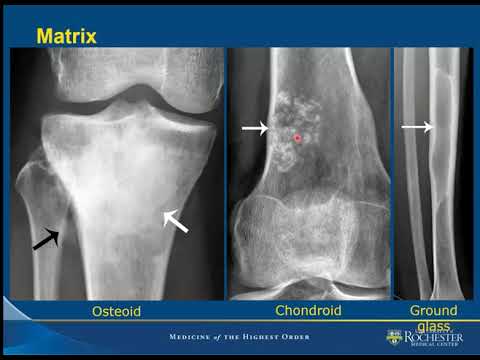 Imaging of Bone Tumors